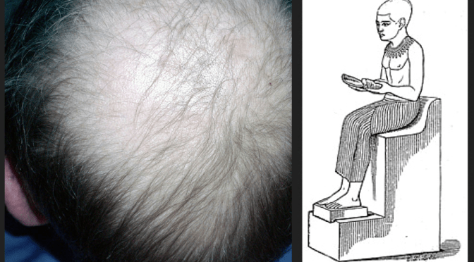 Autumn Meeting 2013. Talks on alopecia, and Imhotep.